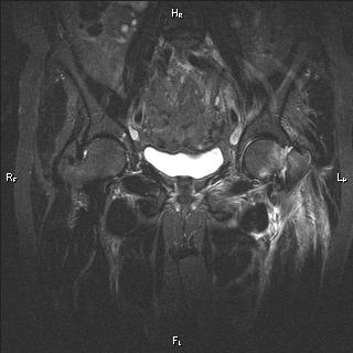 Выявление  транцервикального перелома шейки бедренной кости с помощью МРТ