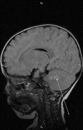 Выявление участков изменения в белом веществе полушарий головного мозга и ножках мозжечка м помощью МРТ