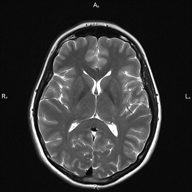 МРТ головного мозга