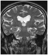 Выявление менингиомы намета мозжечка при помощи МРТ