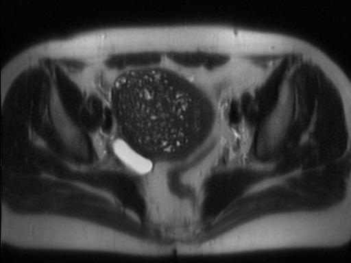 Выявление диффузного аденомиоза и диффузной гиперплазии эндометрия матки с помощью МРТ