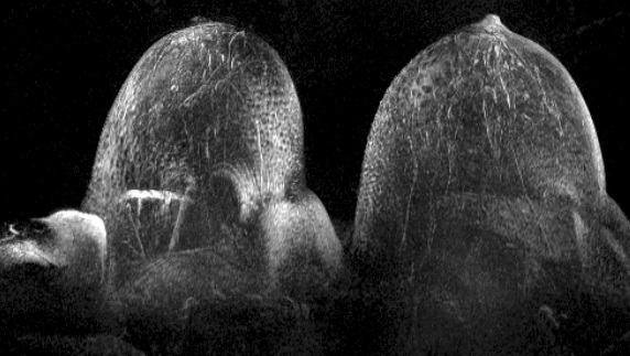 Выявление симметричного диффузного отека соединительной ткани молочной железы